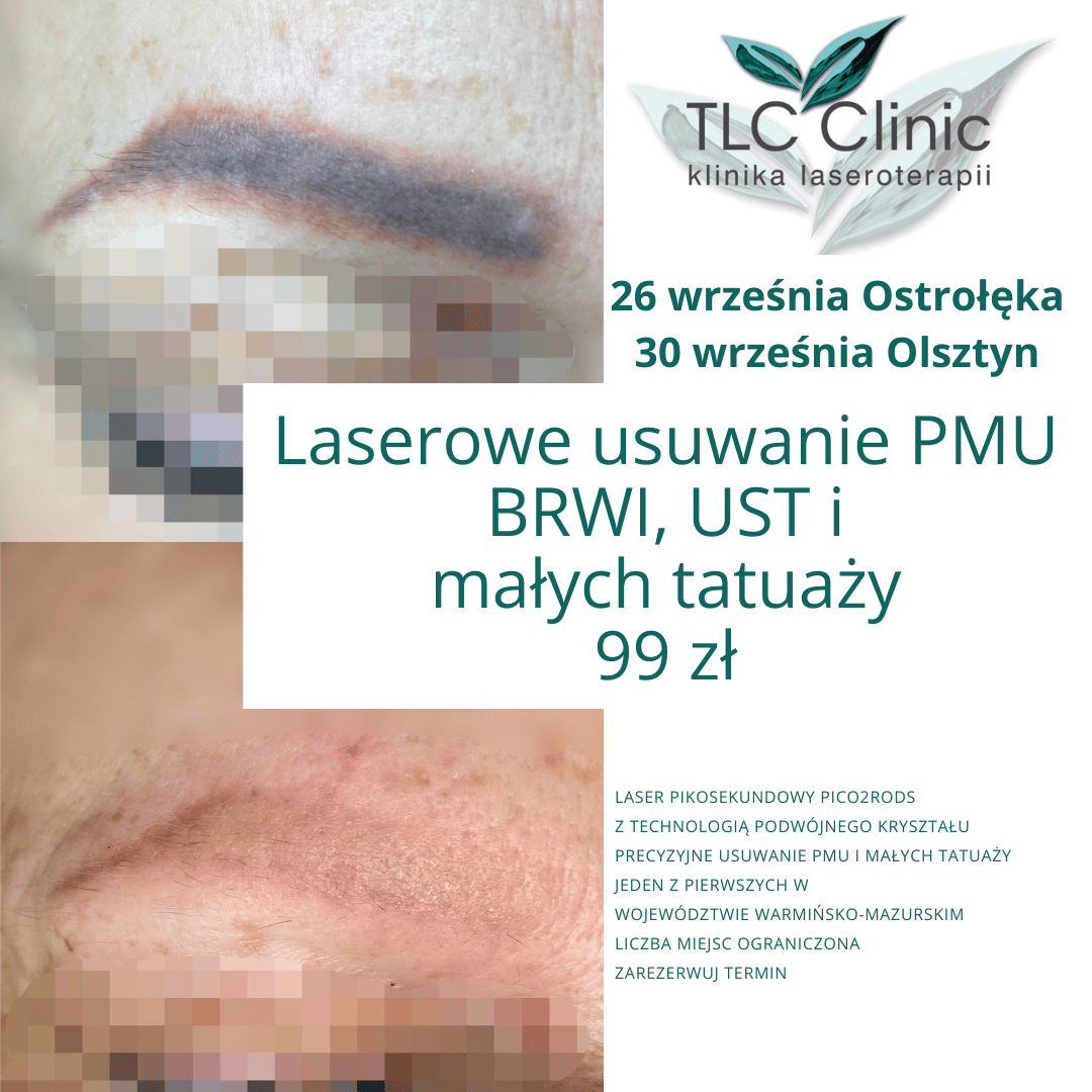 Laserowe Usuwanie PMU i Tatuaży – Wrzesień 2026 | TLC-Clinic